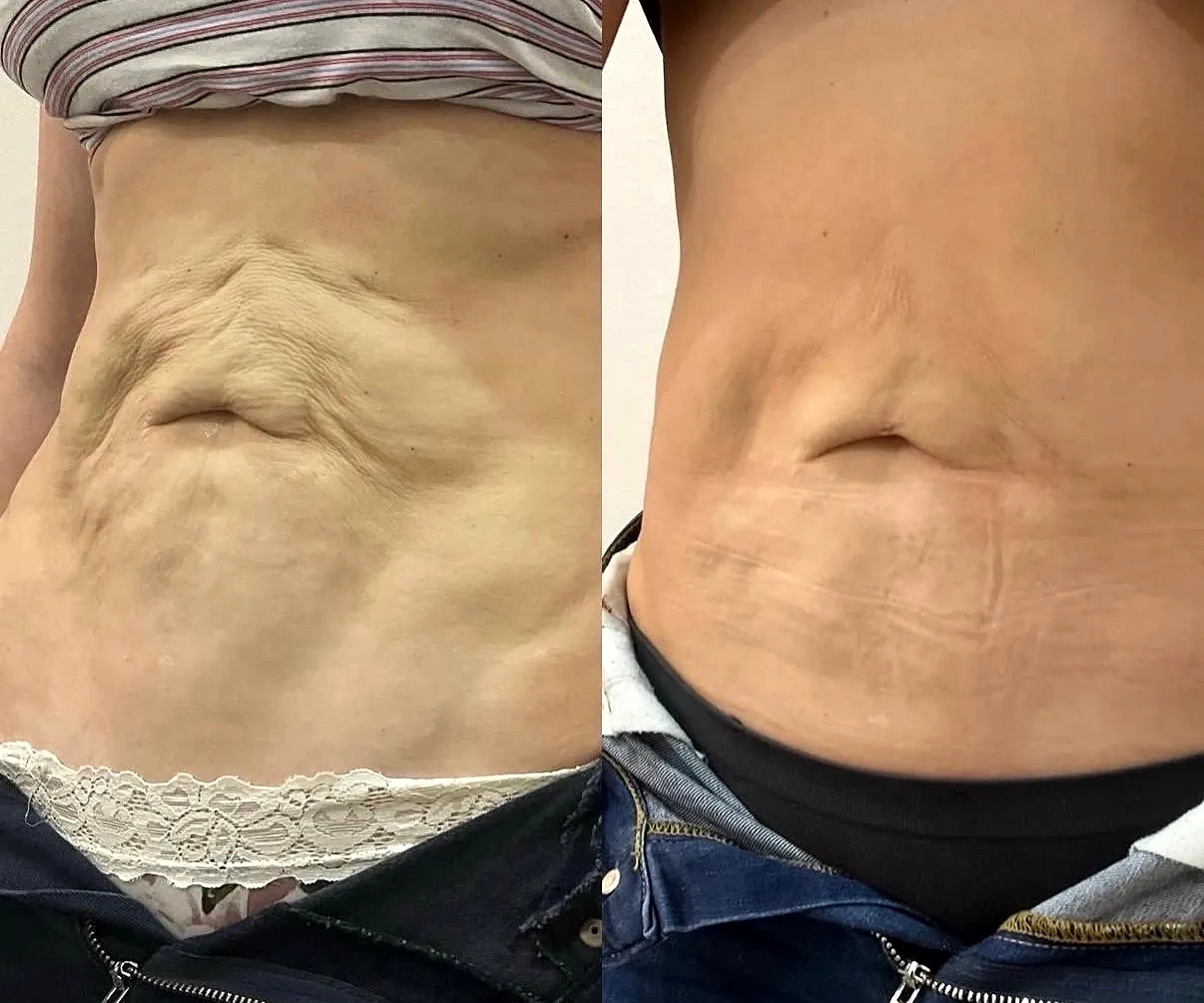 Side-by-side abdomen photographs before and after XERF body tightening