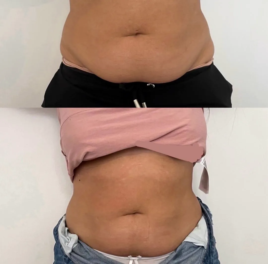 Client-supplied abdomen before-and-after comparison 1