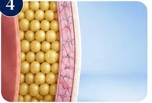 Illustration of CoolSculpting stage 4: See gradual change