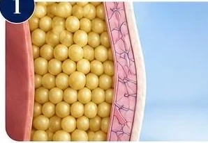 Illustration of CoolSculpting stage 1: Target stubborn fat