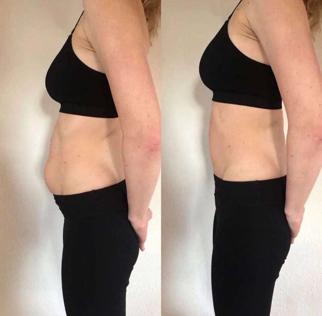 Client-supplied abdomen before-and-after comparison 2