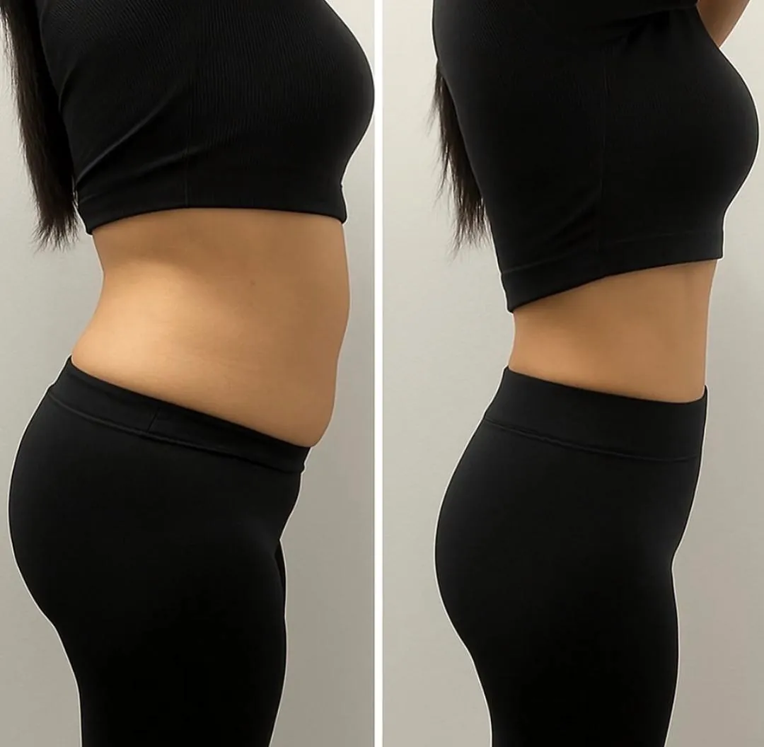 Client-supplied abdomen before-and-after comparison 3
