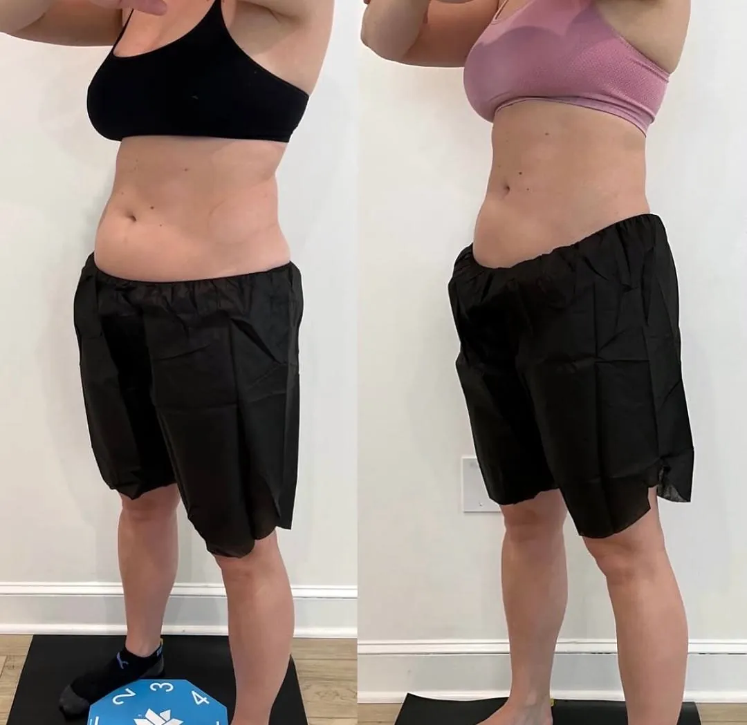 Client-supplied abdomen before-and-after comparison 4