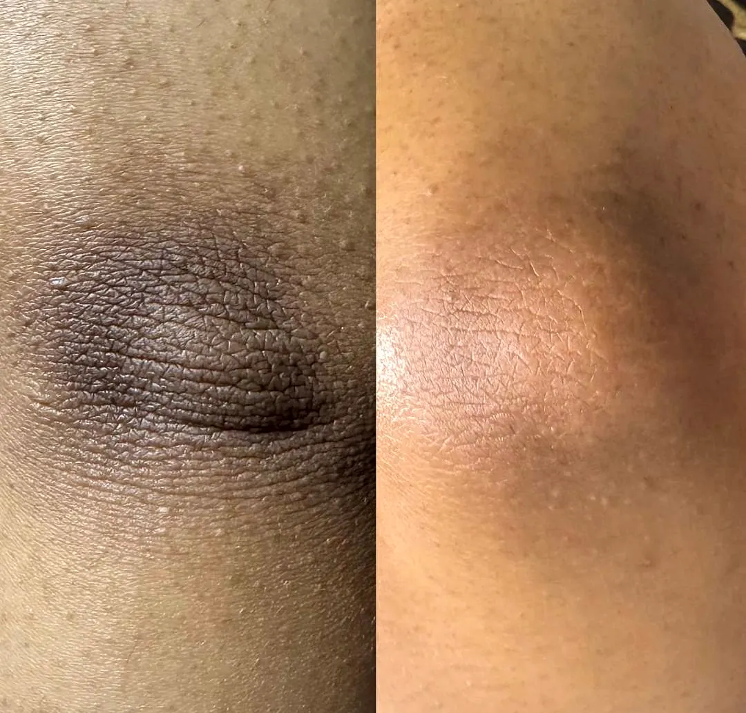 Side-by-side underarm photographs before and after body brightening