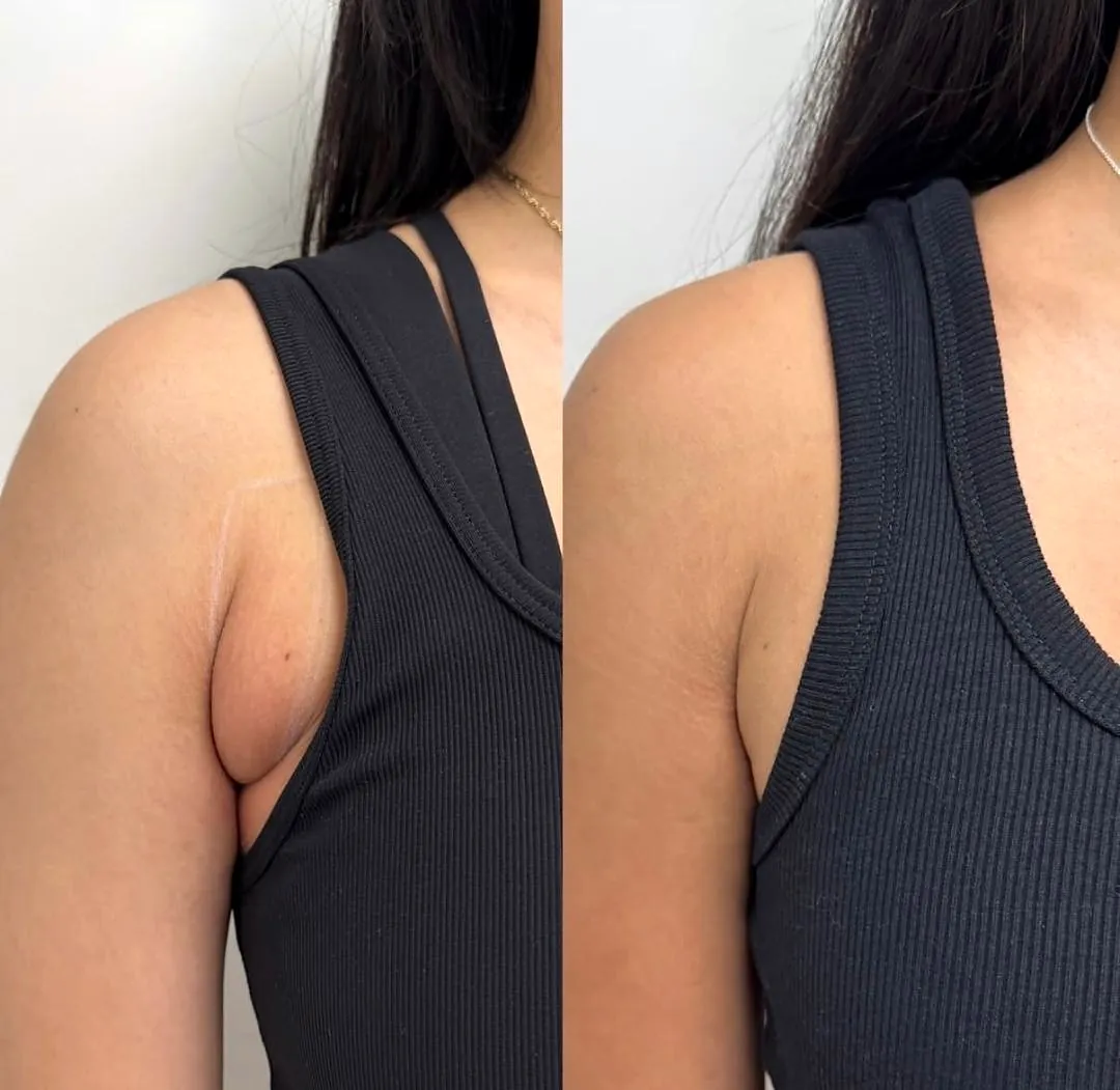 Client-supplied underarm fat before-and-after comparison