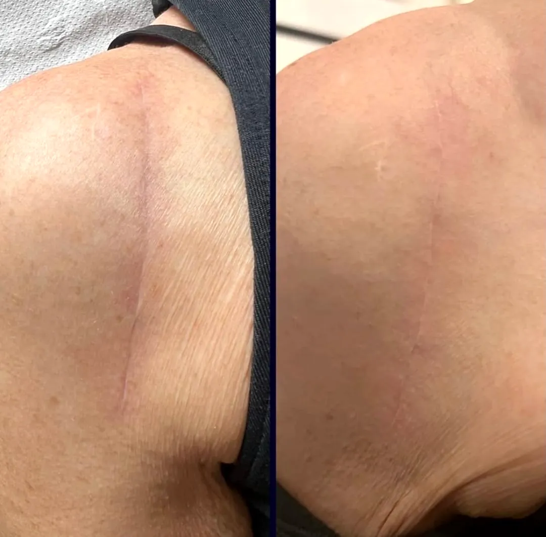 Side-by-side shoulder scar photographs before and after RF microneedling