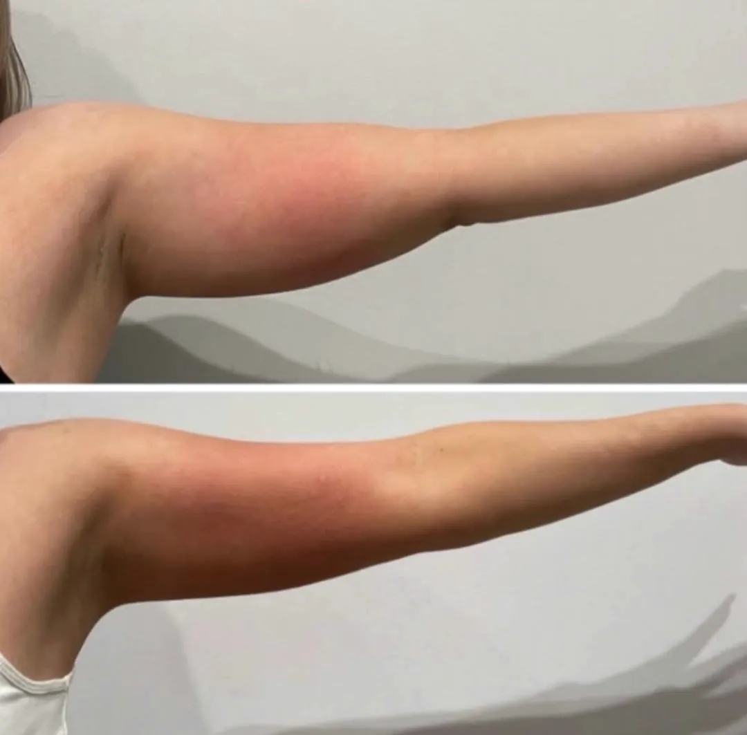 Client-supplied upper arm before-and-after comparison 1