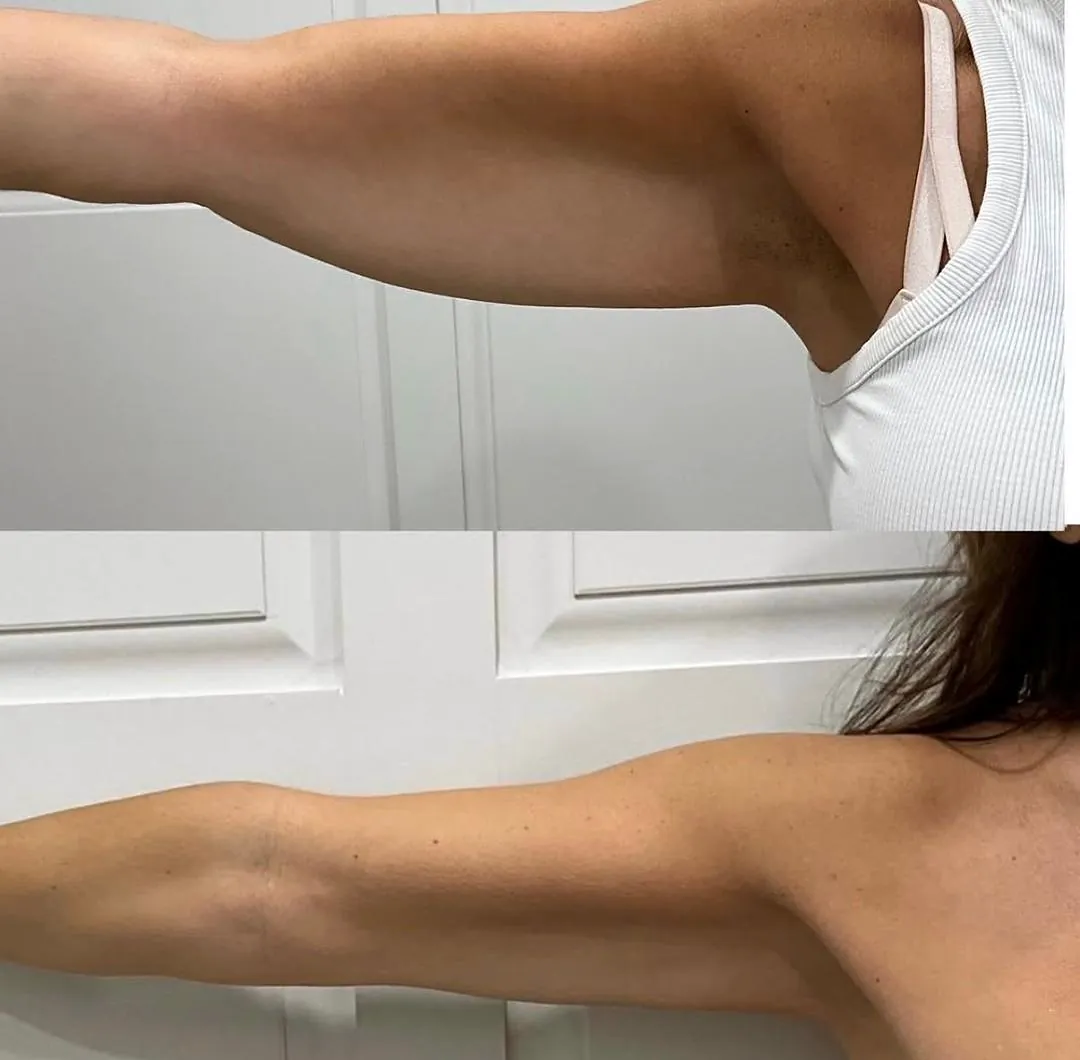 Client-supplied upper arm before-and-after comparison 2